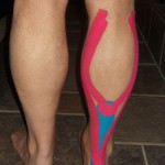 kinesio -kuittaping